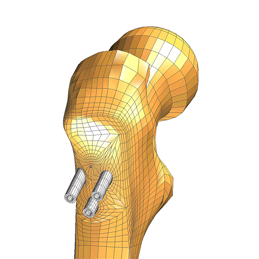 TrueGrid® mesh of femor and implant